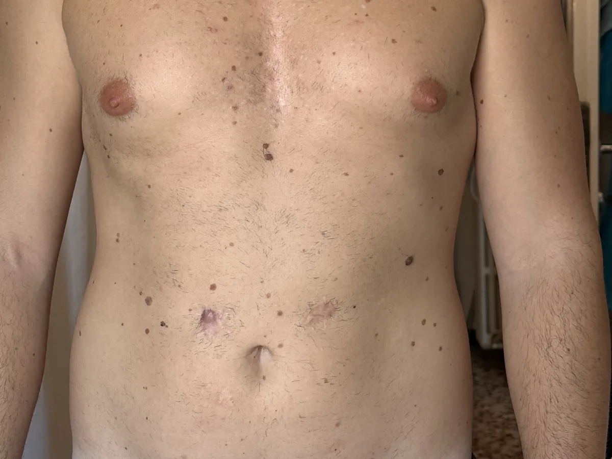 Lo stesso petto otto anni dopo: pelle stabile con cicatrici residue