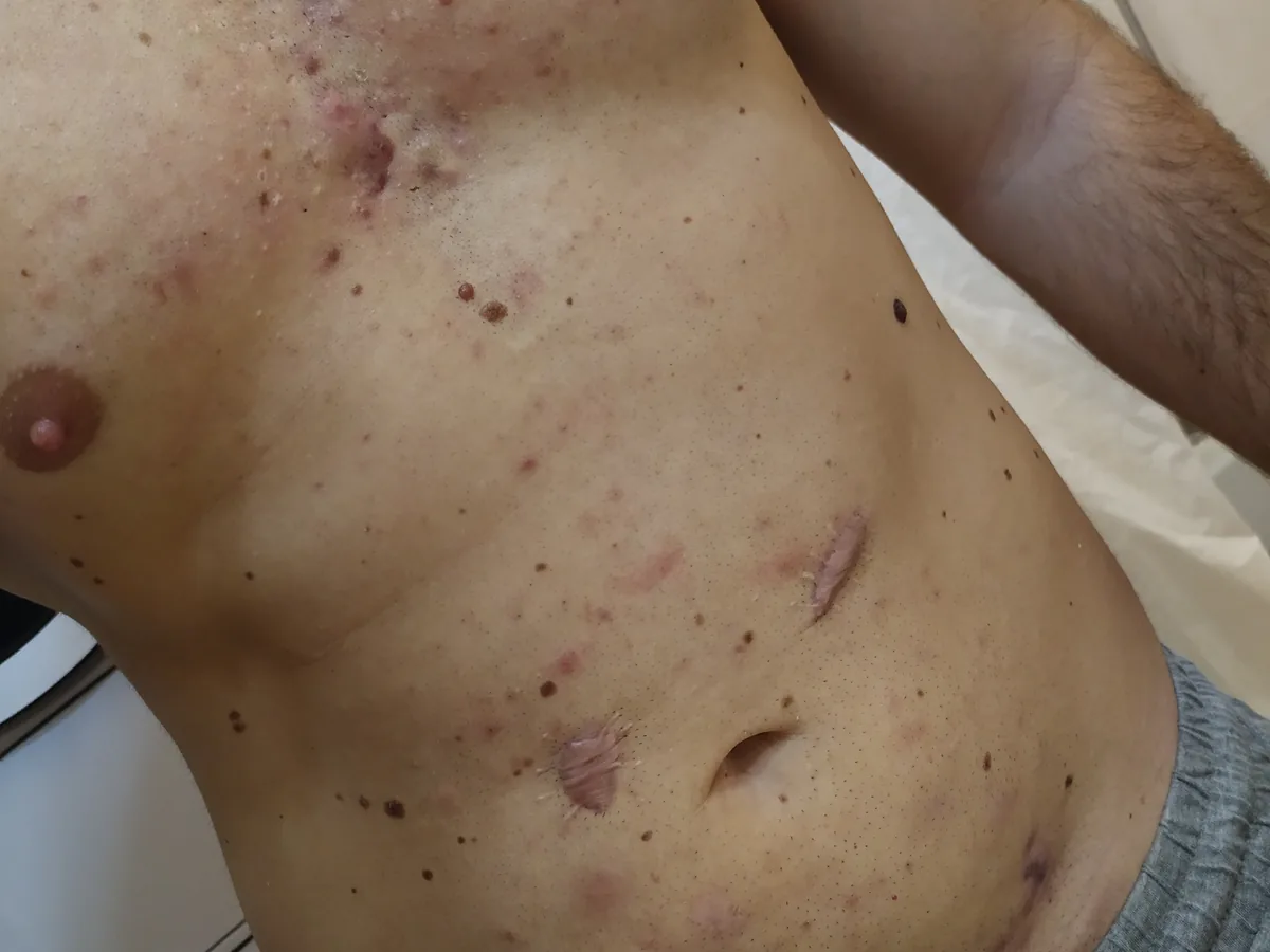 Petto e addome con lesioni attive e cicatrici da Idrosadenite Suppurativa